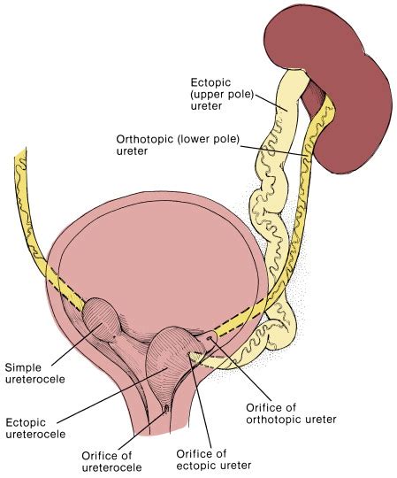 ureteral orifice 中文 – Chicdn