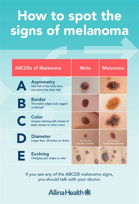 Melanoma and your moles: Know what's new | Allina Health