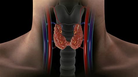 Parathyroid-gland-location-Dr-Larian - Hyperparathyroidism Surgery - Dr ...