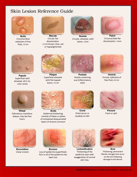 Different Kinds Of Rash Types Of Skin Lesion Cheat Sheet | Images and ...