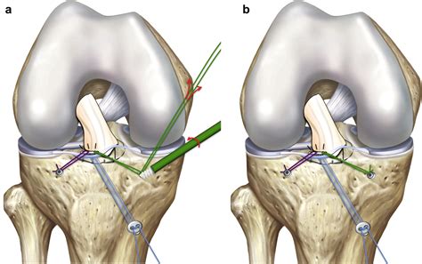 Pediatric & Adolescent Tibial Eminence Fracture | Jeremy M. Burnham, MD