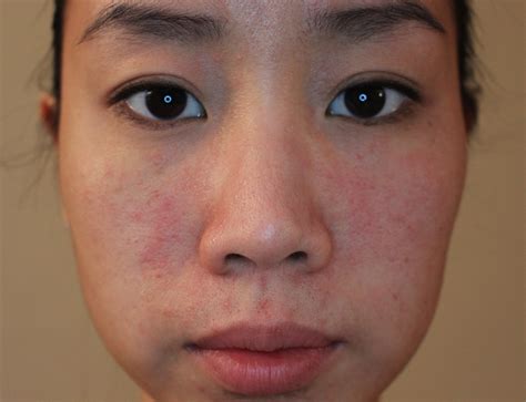 red bumpy rash on face - pictures, photos