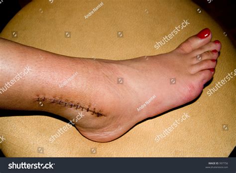 Ankle Surgery Scar With Staples. Stock Photo 997756 : Shutterstock