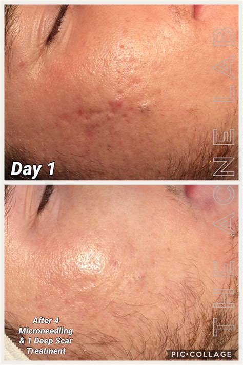 Acne Scars & Hyperpigmentation — The Acne Lab