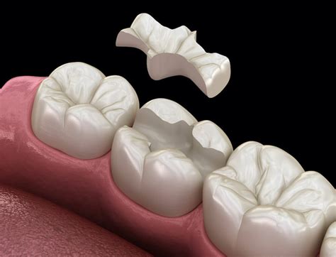 Inlays and Onlays - Tuan Pham DDS