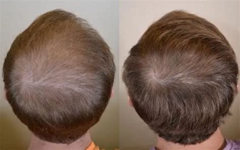 Finasteride Guide: Uses, Results & Side Effects | Wimpole Clinic