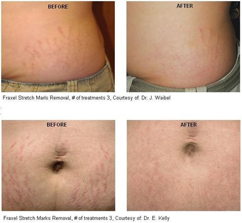 Top 93+ Pictures Laser Treatments For Stretch Marks Before And After ...