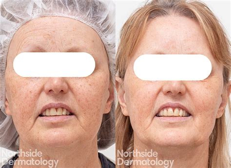 Excel V Depigmentation Treatment Results | Northside Dermatology