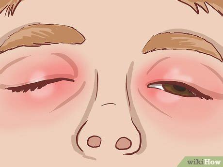 How to Treat Eczema Around the Eyes (with Pictures) - wikiHow