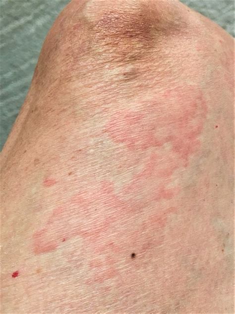 Reasonably Well: Surprises and Chronic Autoimmune Urticaria