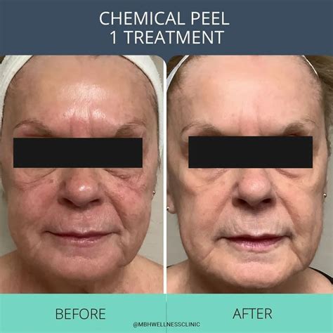 Day by Day Chemical Peel Recovery - The Ultimate Guide