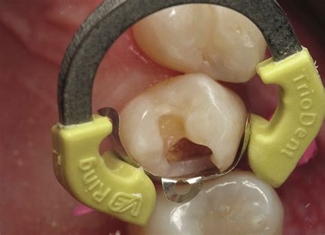 Triodent V3 Sectional Matrix System – Clinical Research Dental