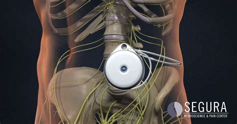 Pain Pump - Segura Neuroscience & Pain Center