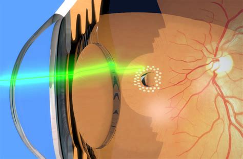 What Is Retinal Laser Photocoagulation?