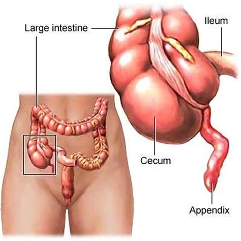 Pictures Of Cecum