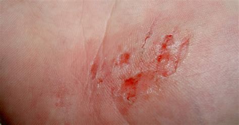 Check these interesting Facts about Abrasions!!