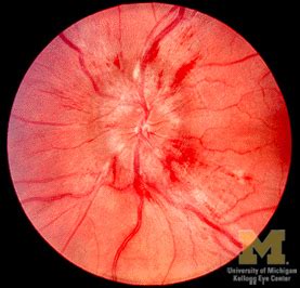 Papilledema - Pictures, Definition, Causes, Symptoms and Treatment