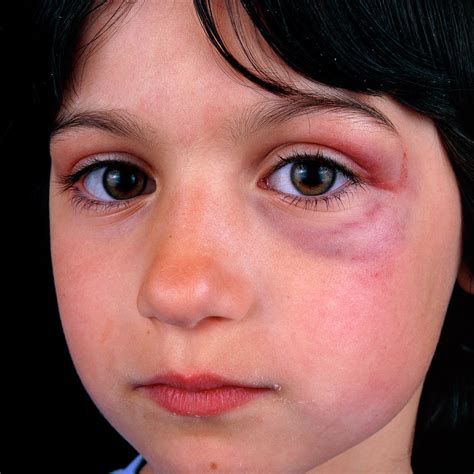 Girl With Black Eye Photograph by Alex Bartel/science Photo Library ...