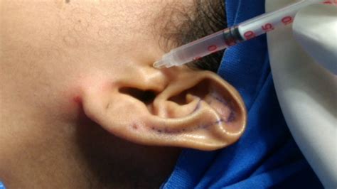 Articulación Adiccion Fascinante auricular nerve block sanar Repegar Moral