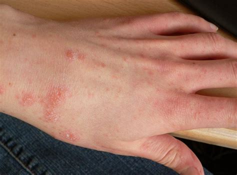 Scabies Pictures And Symptoms