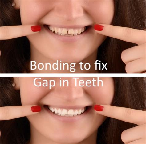 Dental Bonding | Frisco, TX | Bonding Cost | Highland Oak Dental