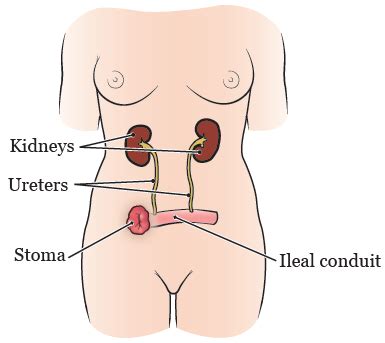 About Your Bladder Surgery With an Ileal Conduit (Urostomy) | Memorial ...