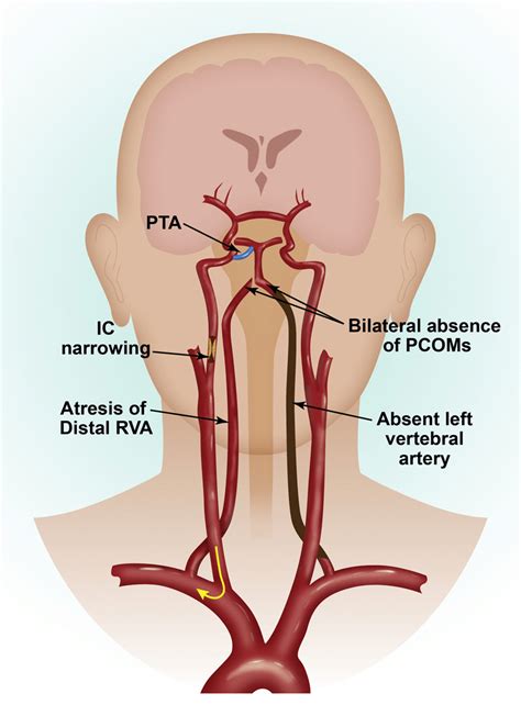 Occluded Left Internal Carotid Artery