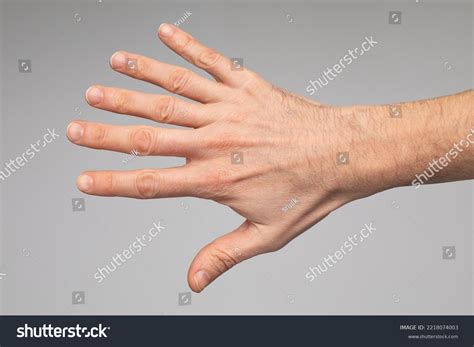 Case Polidactyly Close Hand Man Hexadactyly Stock Photo 2218074003 ...