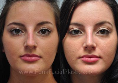 Rhinoplasty for a Bulbous Tip - Wide Nasal Tip Surgery | Funk Facial ...