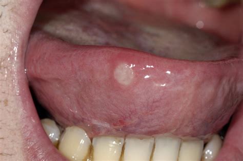 Mouth ulcers - NHS