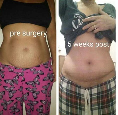 Top 99+ Pictures Tummy Tuck After C Section Pictures Excellent