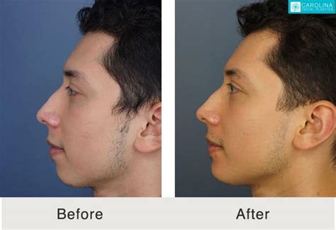 5 Solutions for an Aging Jawline - Carolina Facial Plastics