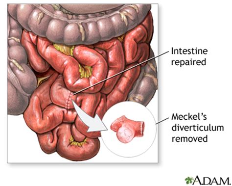 Meckel's diverticulectomy - series—Procedure: MedlinePlus Medical ...