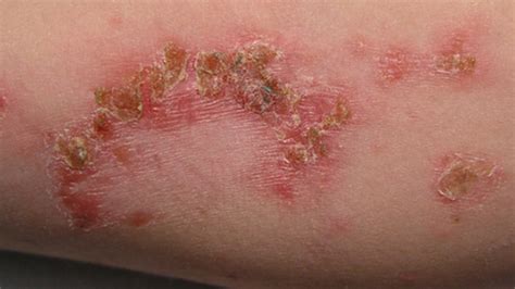 734 Images Of Viral Skin Infections free Download - MyWeb