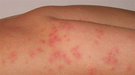 Pin Worms Rash