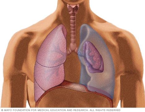 Pneumothorax - Symptoms and causes - Mayo Clinic