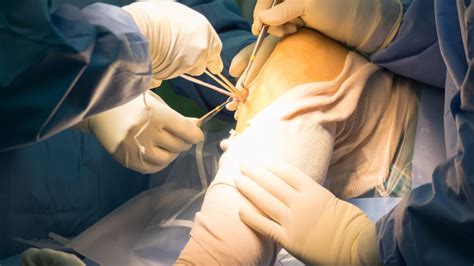 ACL Reconstruction: Still the Gold Standard? - Keck Medicine of USC