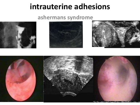 Ashermans and hysteroscopic adhesion preventions