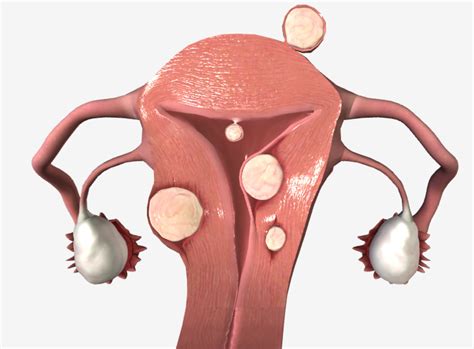 Abnormal Uterine Bleeding Concise Medical Knowledge - EroFound