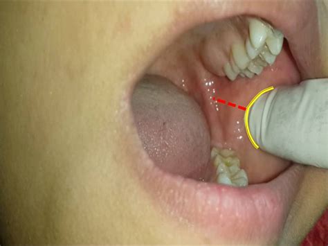 Inferior Alveolar Nerve Block - slidesharetrick