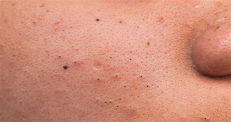 Blackheads - Causes, Symptoms, Treatments, and Prevention