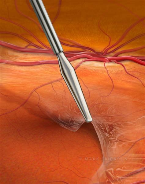 Epiretinal membrane peel, vitreoretinal surgery illustration