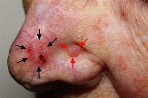 Basal Cell Carcinoma - Causes, Types, Symptoms, Prognosis, Treatment