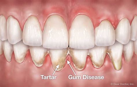 Periodontal Flap Surgery | Coastal Periodontics & Implant Dentistry ...