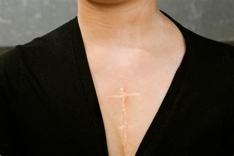 Open Heart Surgery Scar Healing: How to care scars | Miami, FL