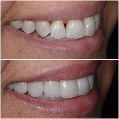 veneers near me before and after - Teofila Arredondo