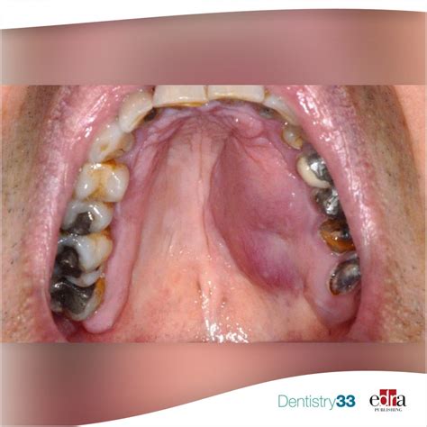 Palatal swelling: a clinical case | Dentistry33