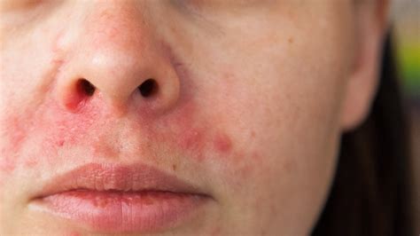 Perioral Dermatitis: Causes, Symptoms, Treatment | Gladskin