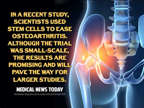 Stem Cell Therapy for Arthritis - Peter A. Fields, MD, DC