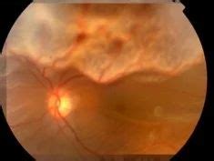 Laser Photocoagulation Retina Services in Dehradun | ID: 7939044373